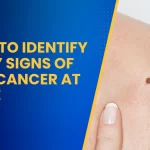 How to Identify Early Signs of Skin Cancer at Home